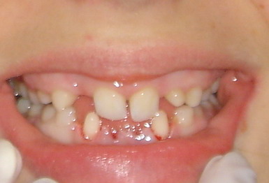 1. Brak zawiązków 17 zębów stałych